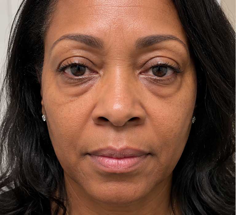 Before Treatment Condition